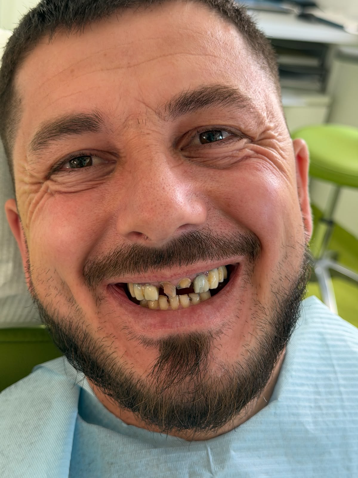 Situația inițială cu dinți fracturați si lucrări vechi incorect adaptate.